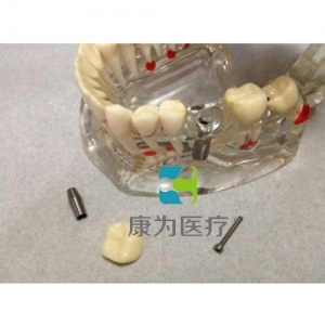 定安县“康为医疗”综合病理水晶牙列模型(可拆)
