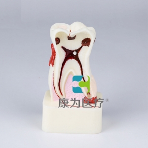 上海“康为医疗”四倍牙齿综合病模型